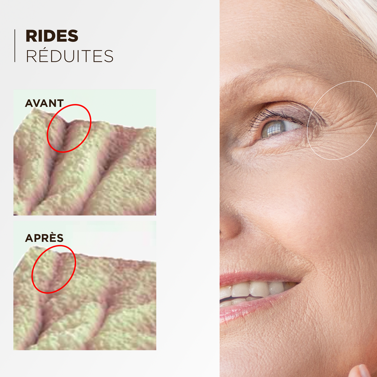 Comparatif avant après : rides du contour de l'œil réduites