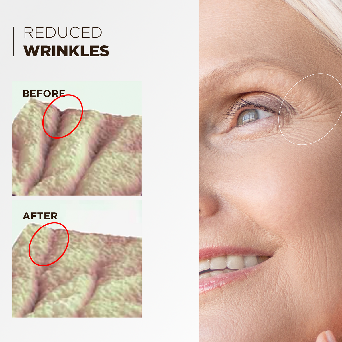 Before and after comparison: reduced wrinkles around the eye