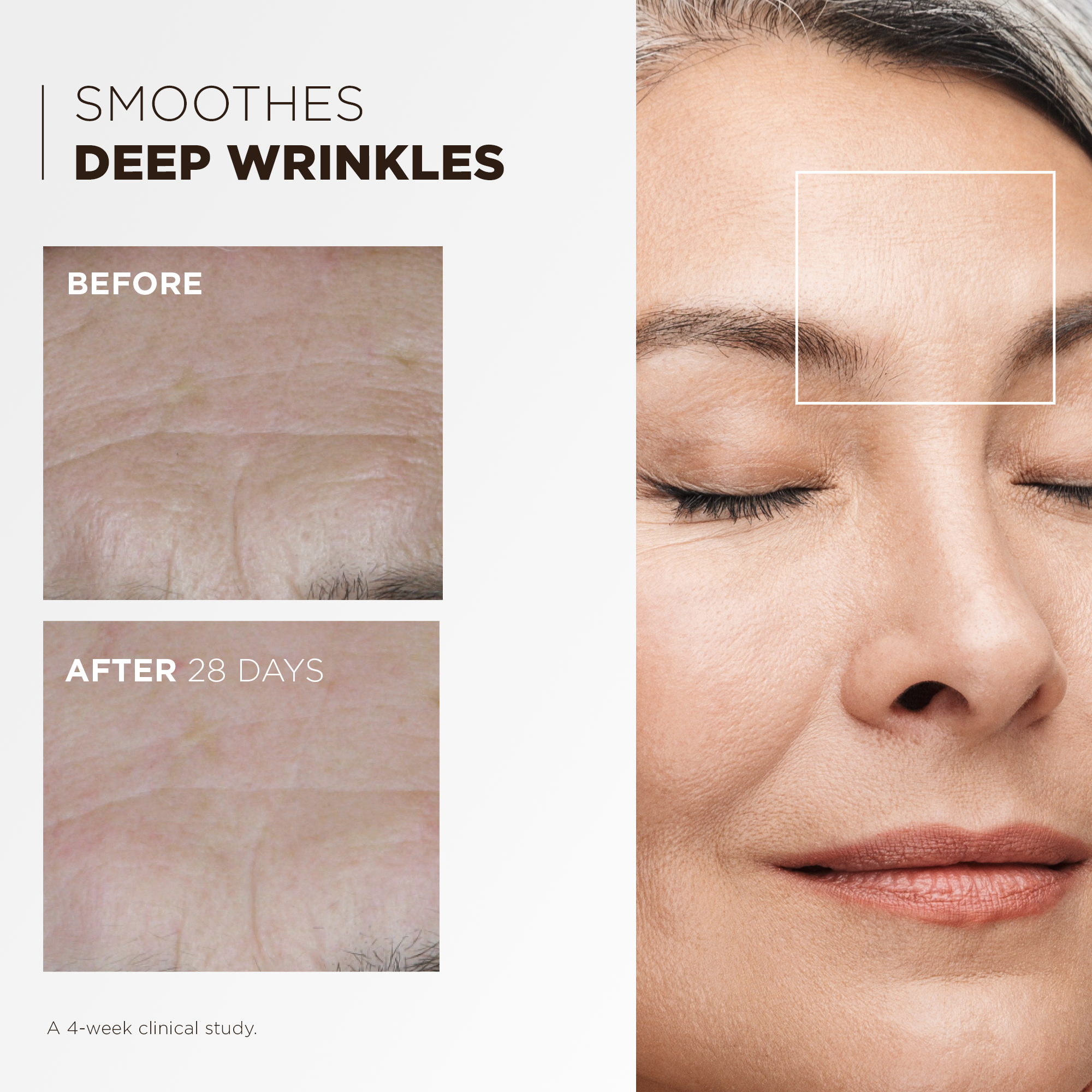 Before and after 28 days: deep wrinkles smoothed