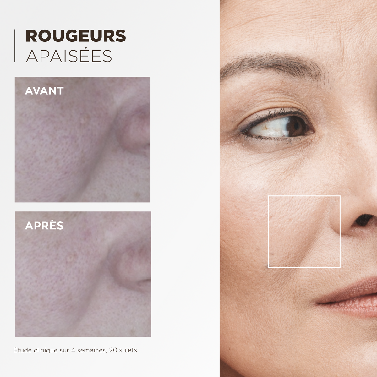 Comparatif avant après : rougeurs apaisées, étude clinique sur 4 semaines