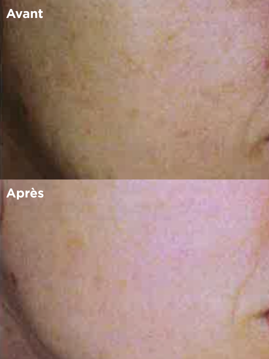 Résultats cliniques du Sérum Resvératrol HUYGENS