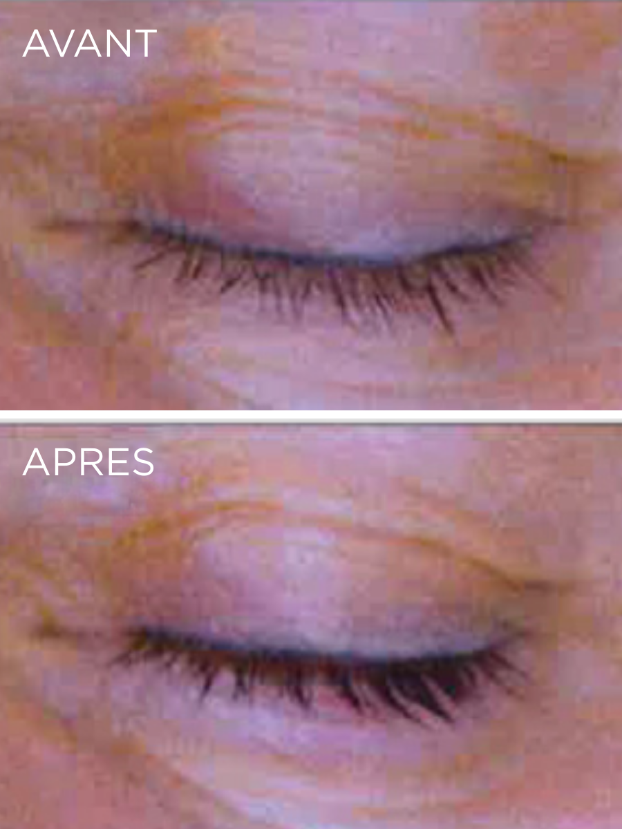 Résultats cliniques du Sérum Resvératrol HUYGENS