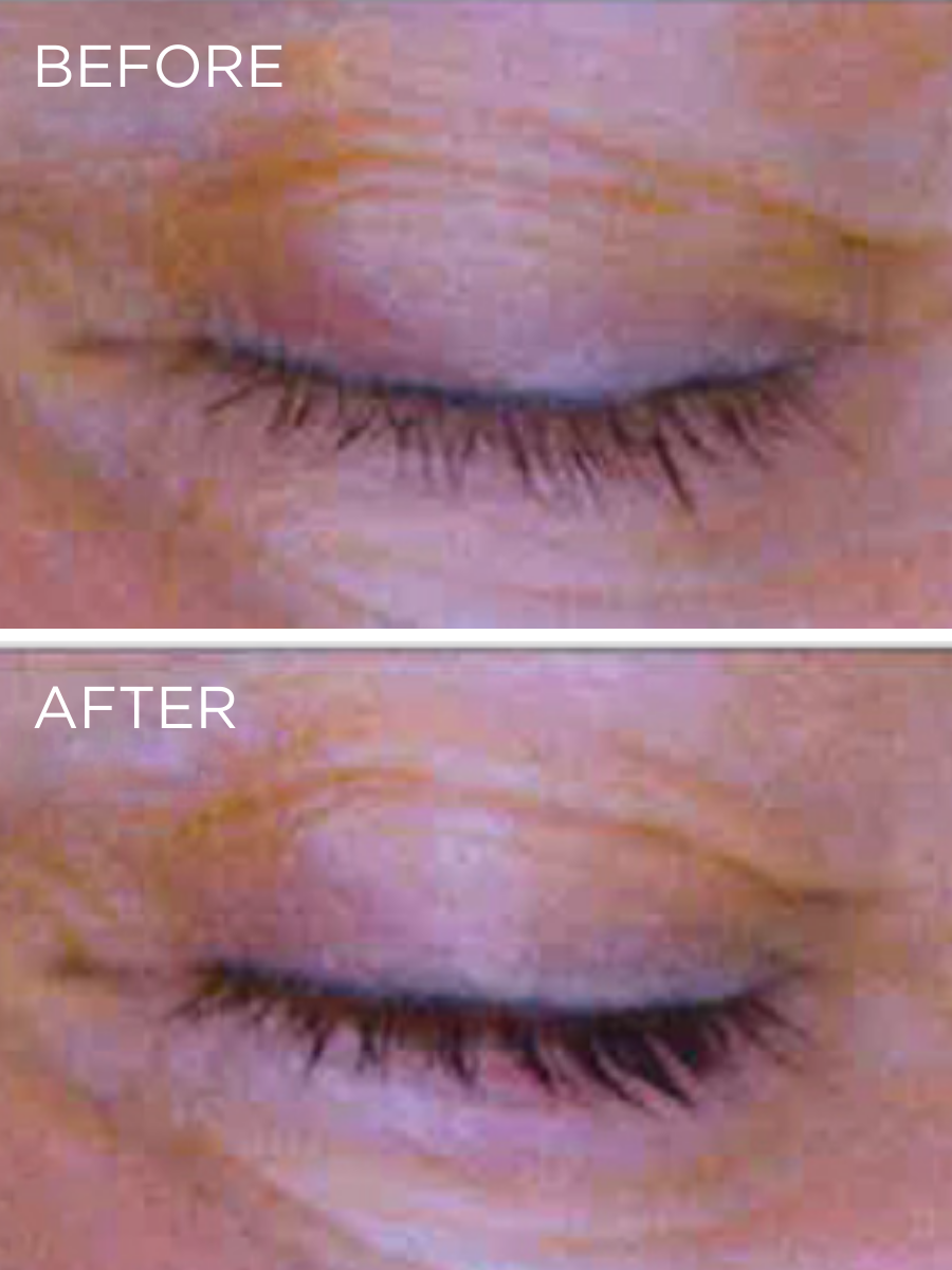 Clinical results of the HUYGENS Lash & Brow Booster