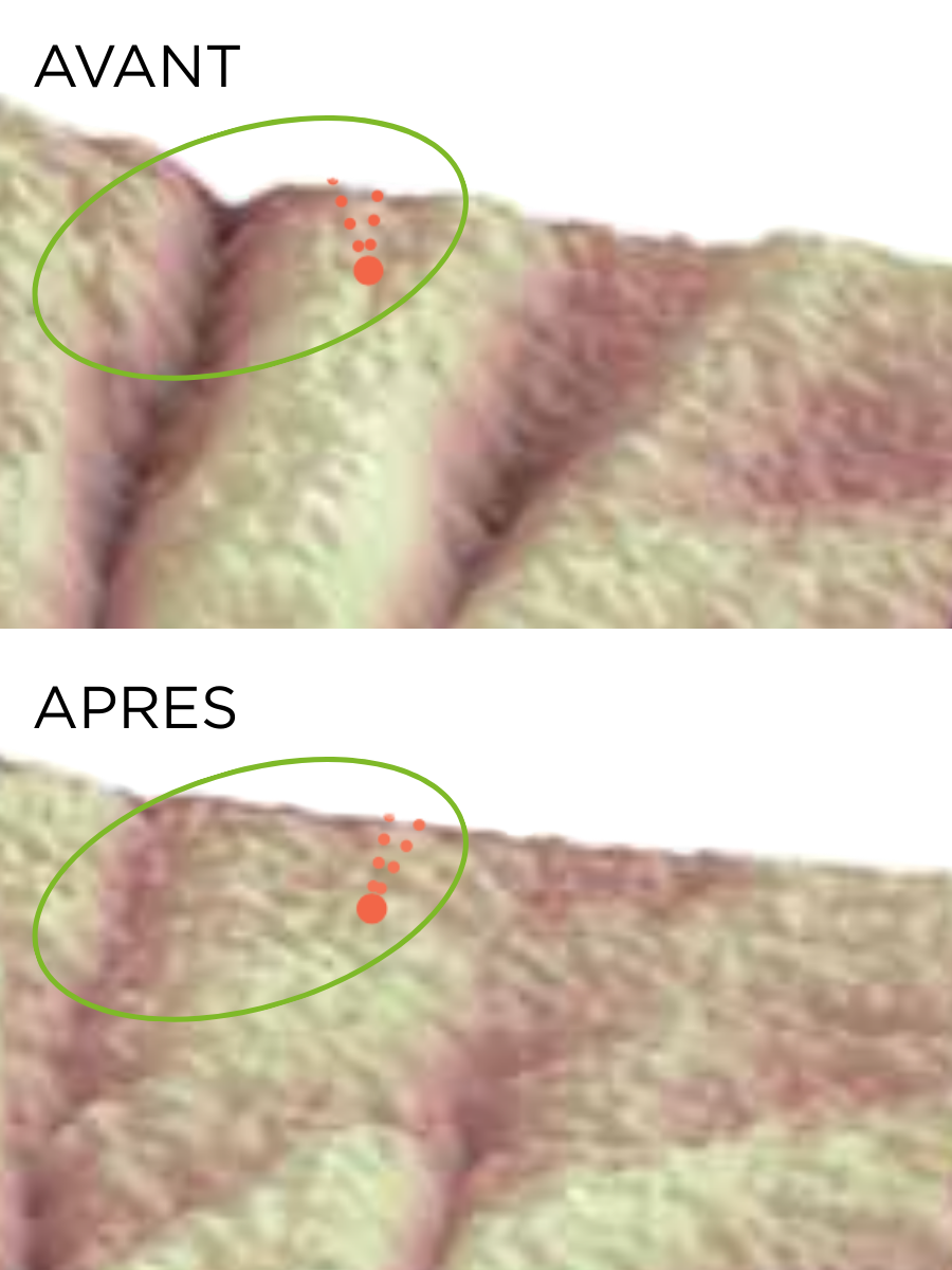 Résultats cliniques du Contour des Yeux HUYGENS