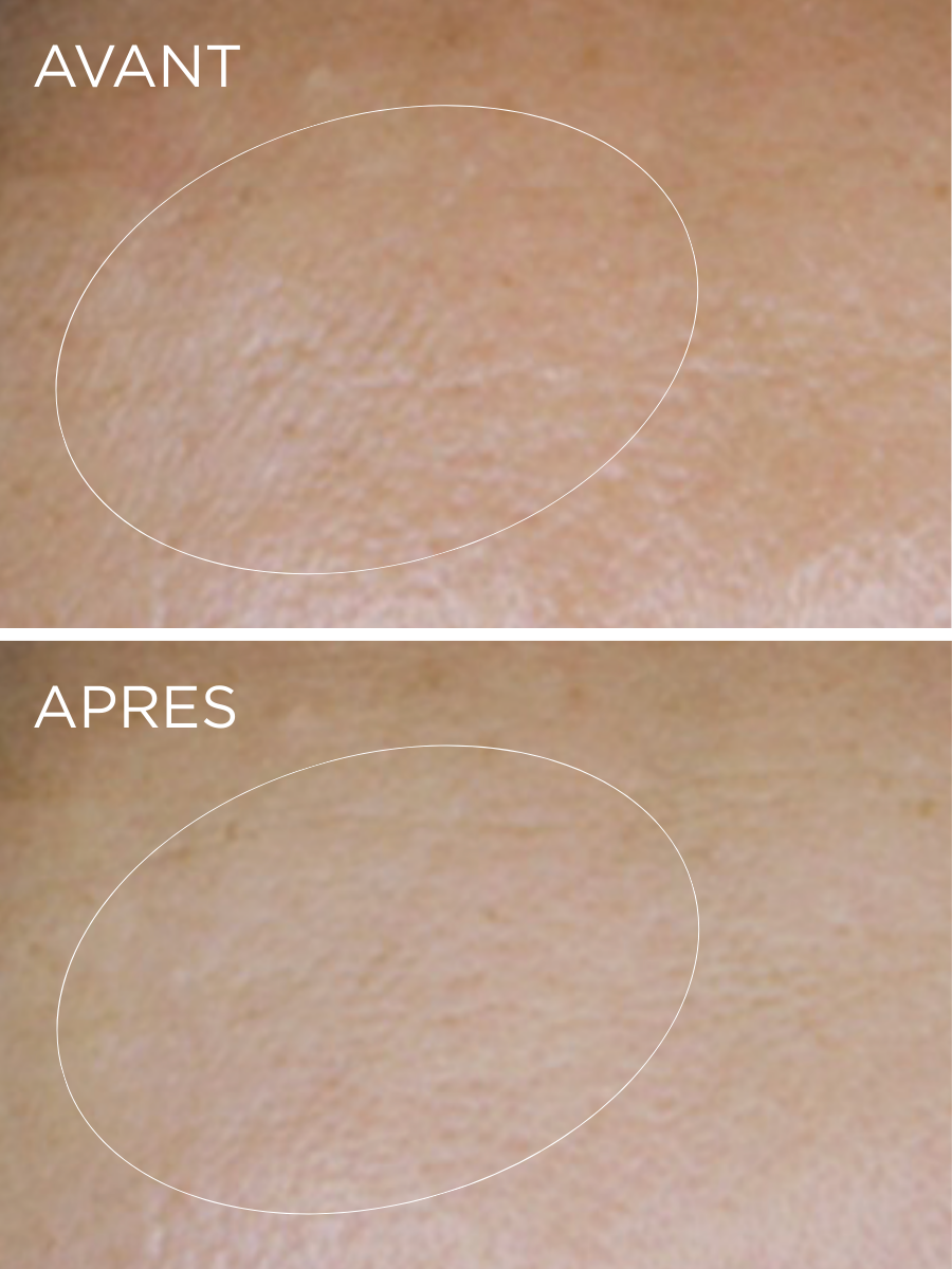 Clinical results of the HUYGENS Hyaluronic Cream