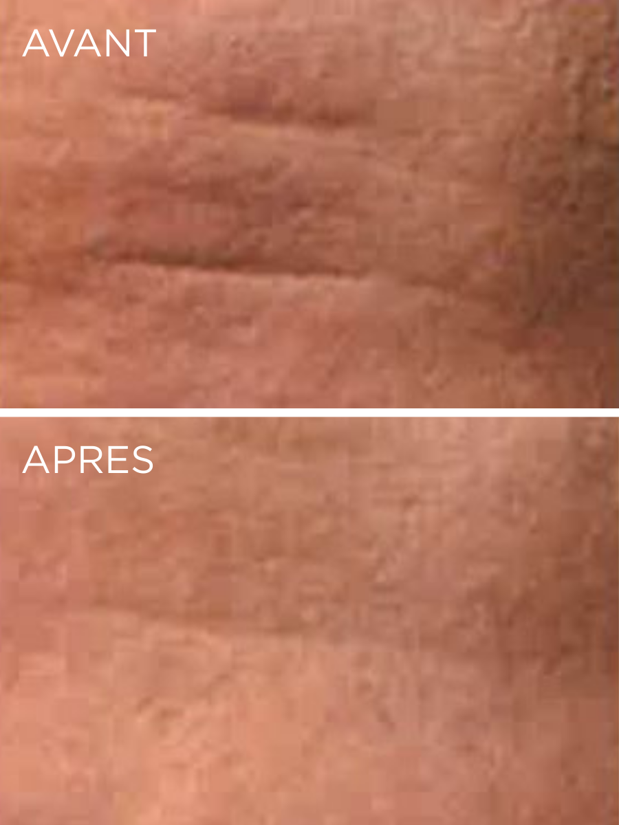 Résultats cliniques de la Crème Lift & Fermeté HUYGENS