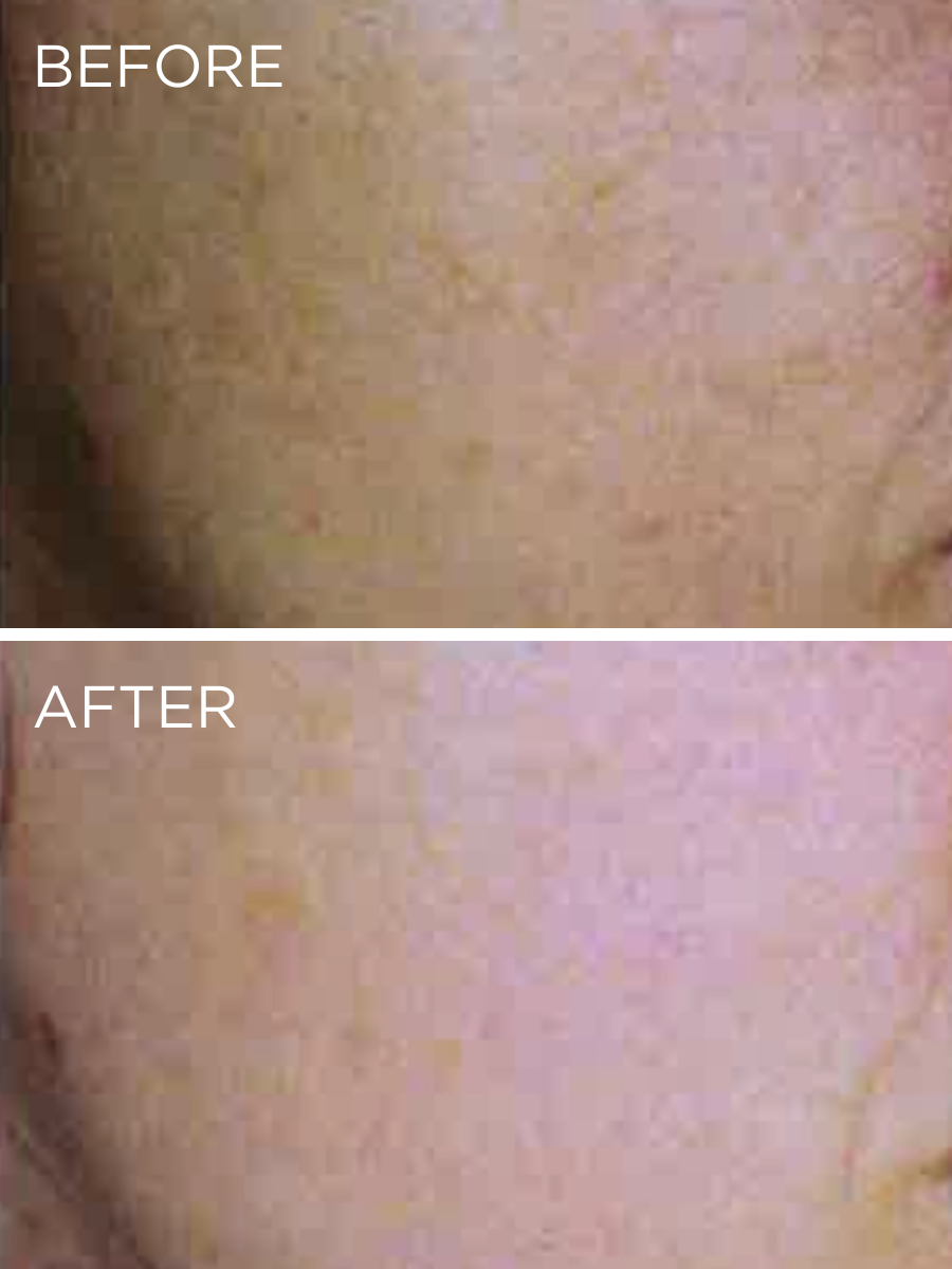 Clinical results of the HUYGENS Resveratrol Serum